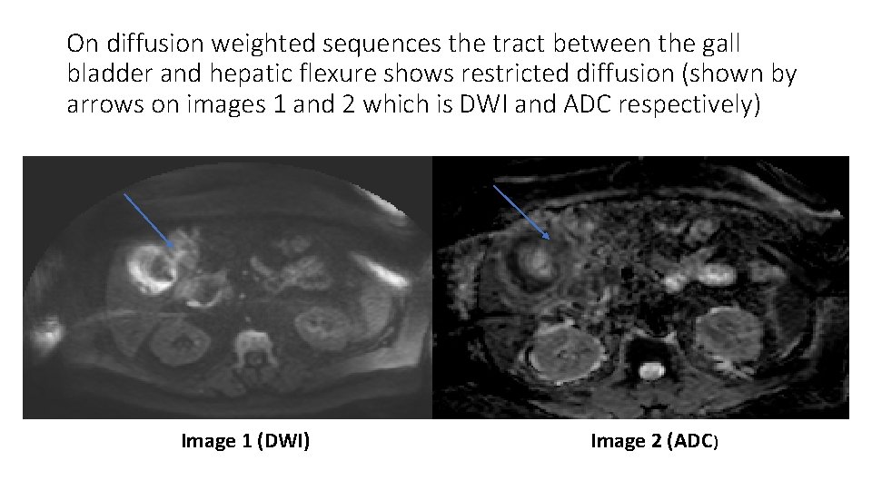 On diffusion weighted sequences the tract between the gall bladder and hepatic flexure shows