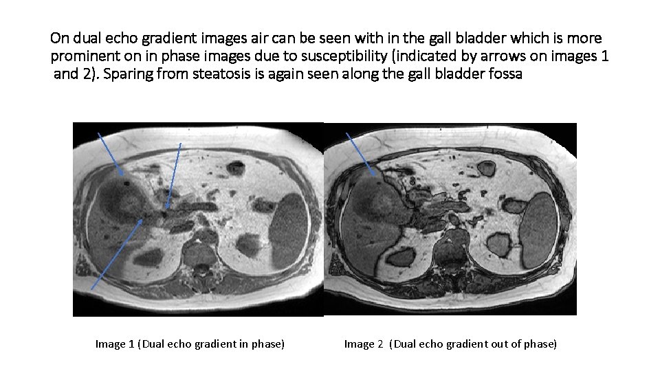 On dual echo gradient images air can be seen with in the gall bladder