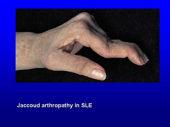 Jaccoud arthropathy in SLE 
