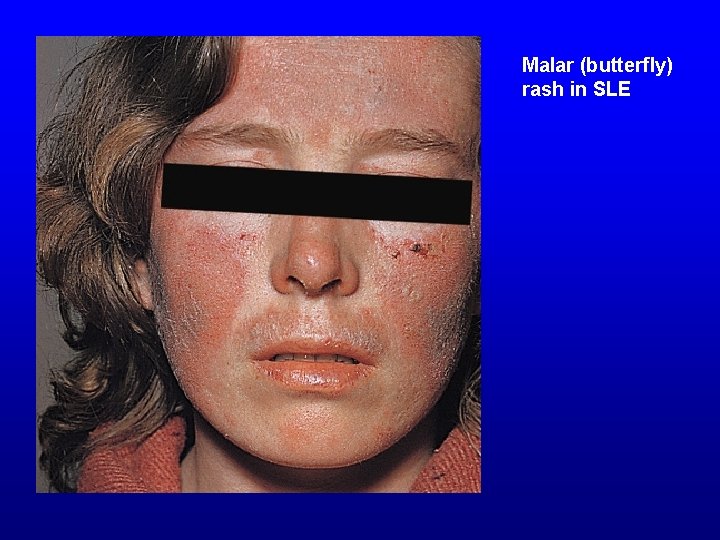 Malar (butterfly) rash in SLE 