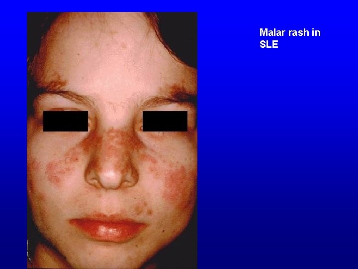Malar rash in SLE 
