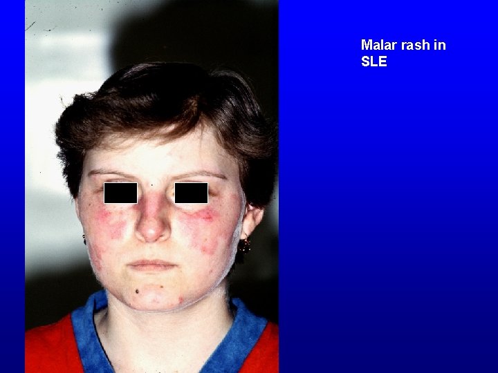 Malar rash in SLE 