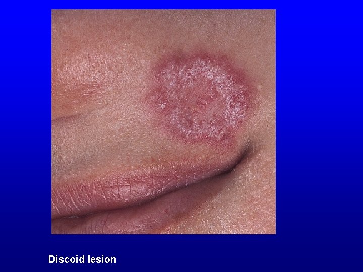 Discoid lesion 