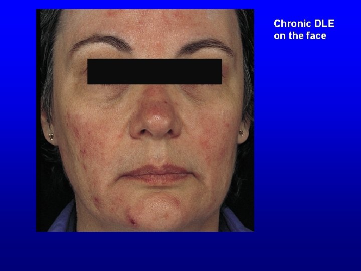 Chronic DLE on the face 