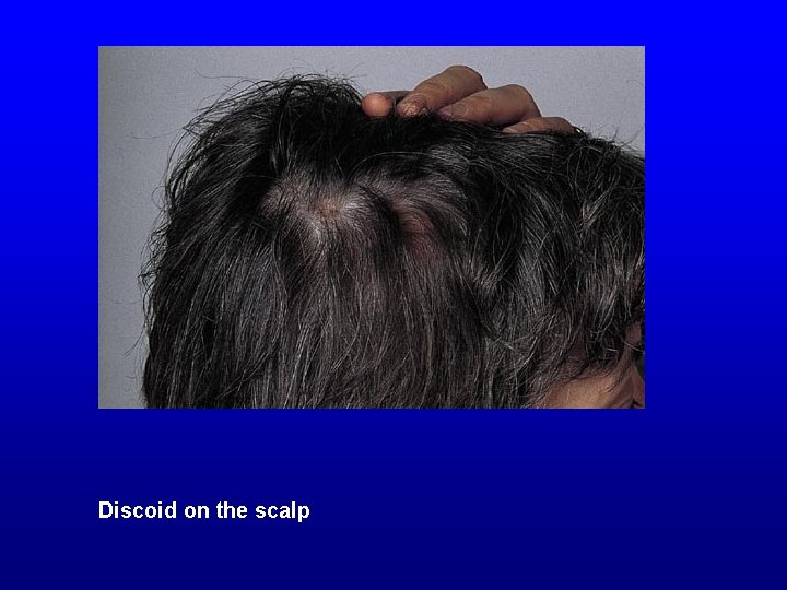Discoid on the scalp 