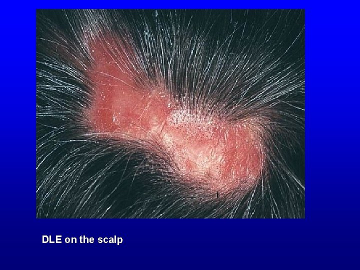 DLE on the scalp 