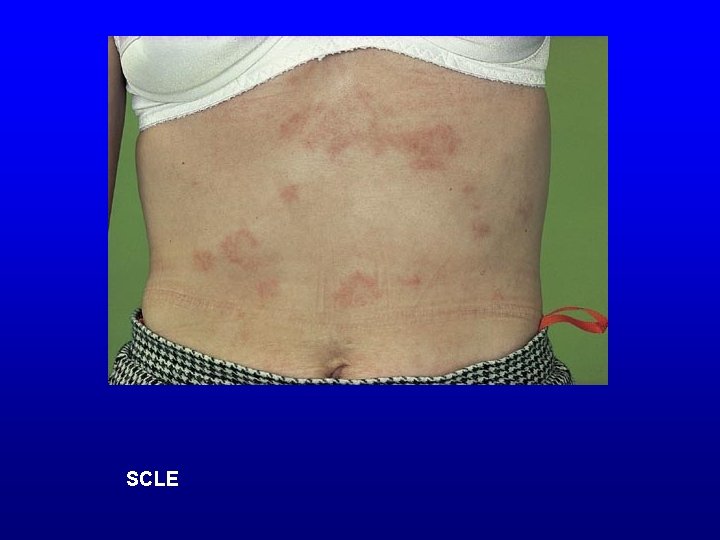 SCLE 