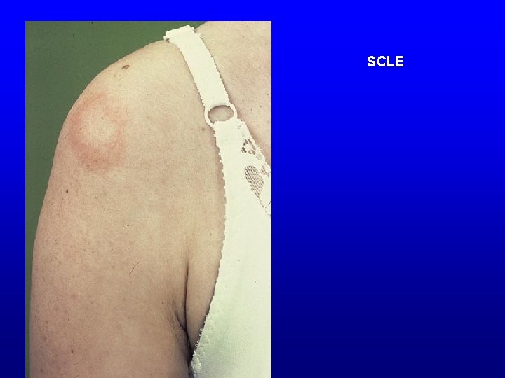 SCLE 
