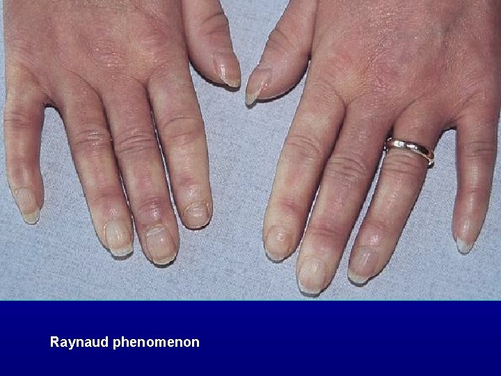 Raynaud phenomenon 