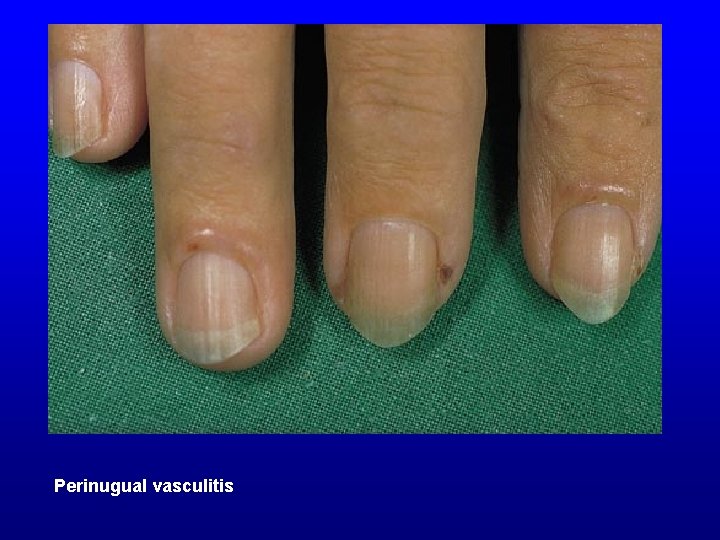 Perinugual vasculitis 