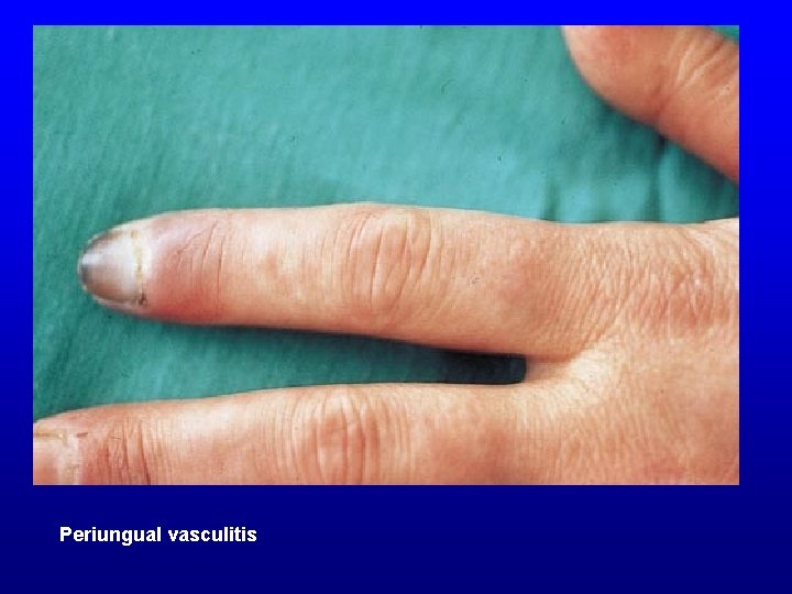 Periungual vasculitis 