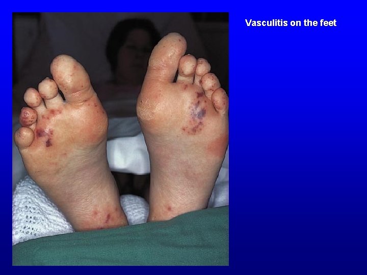 Vasculitis on the feet 