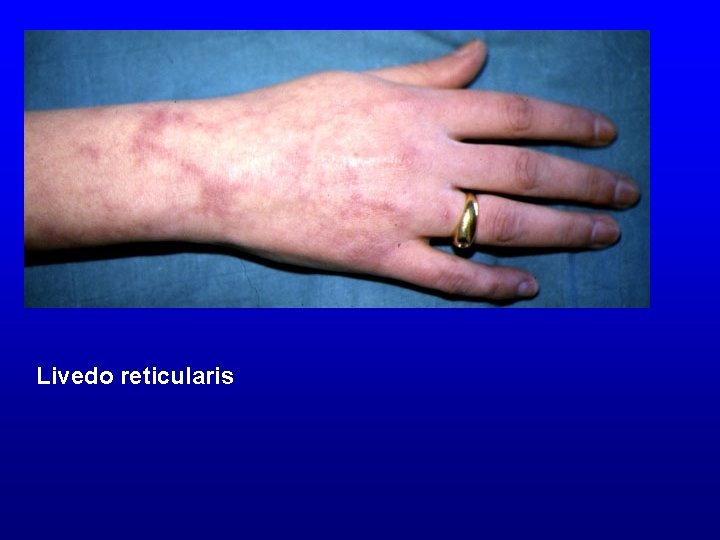 Livedo reticularis 