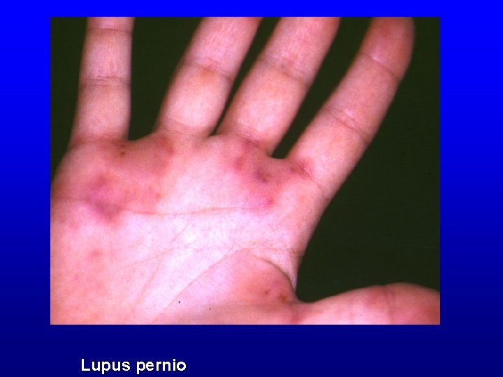 Lupus pernio 