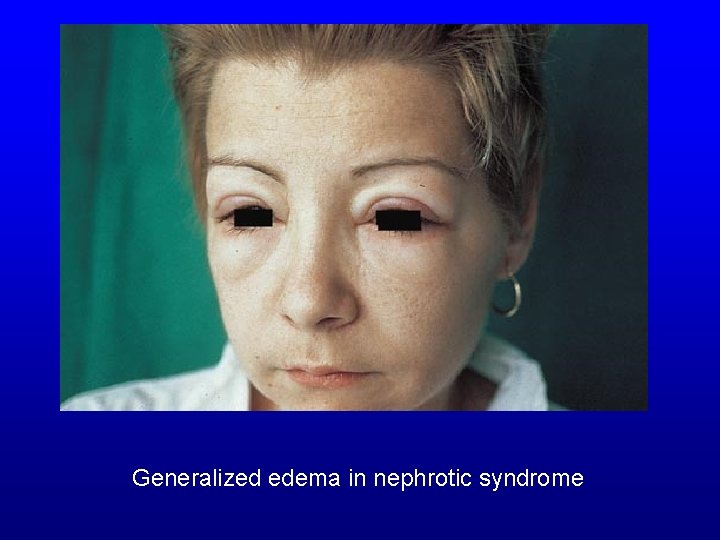 Generalized edema in nephrotic syndrome 