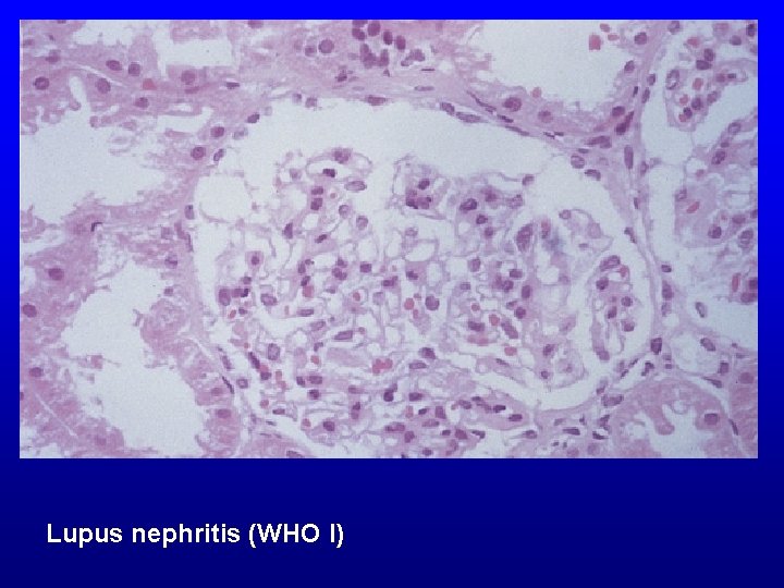 Lupus nephritis (WHO I) 