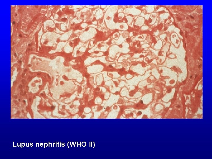 Lupus nephritis (WHO II) 