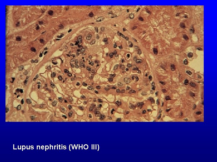 Lupus nephritis (WHO III) 