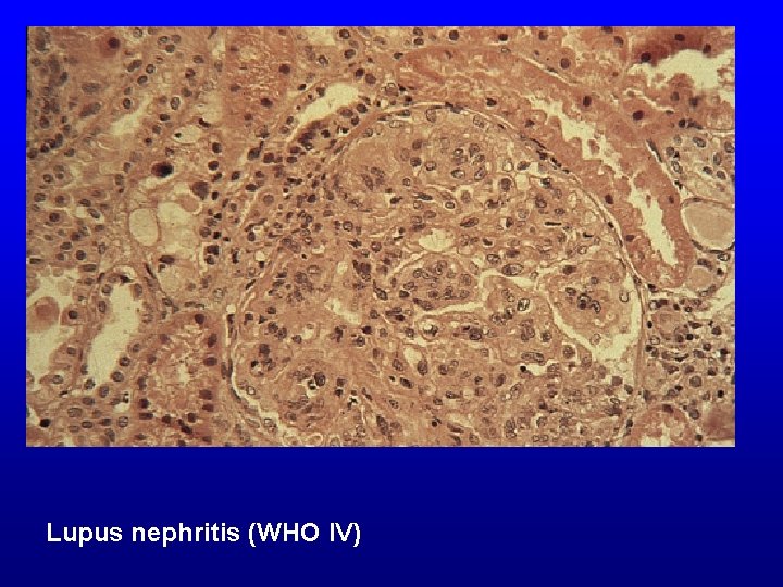 Lupus nephritis (WHO IV) 