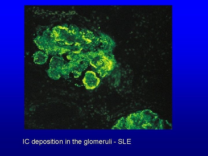 IC deposition in the glomeruli - SLE 