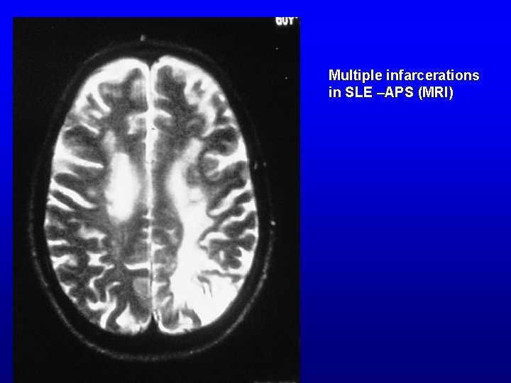 Multiple infarcerations in SLE –APS (MRI) 