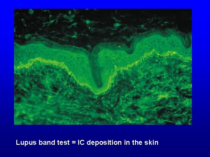 Lupus band test = IC deposition in the skin 