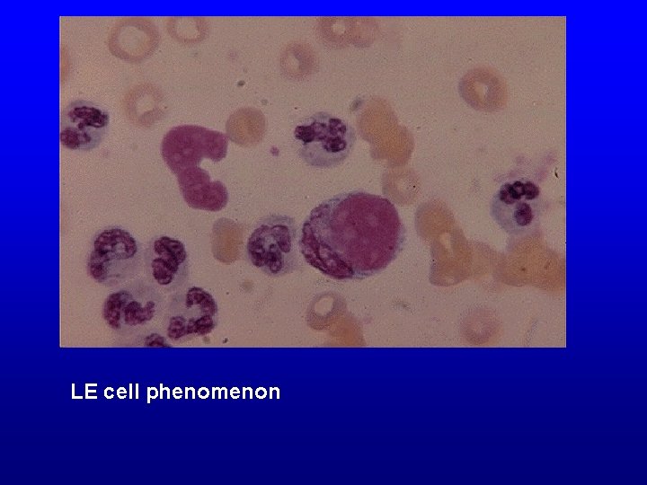 LE cell phenomenon 