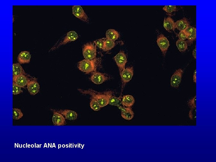 Nucleolar ANA positivity 