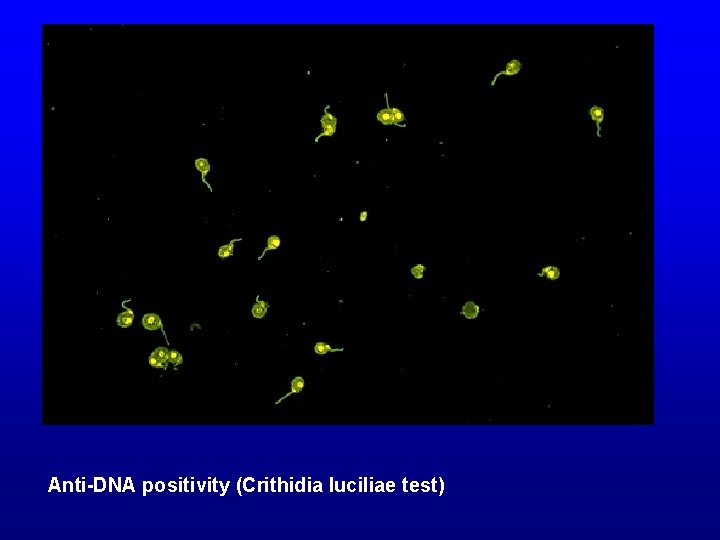 Anti-DNA positivity (Crithidia luciliae test) 