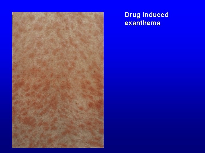 Drug induced exanthema 