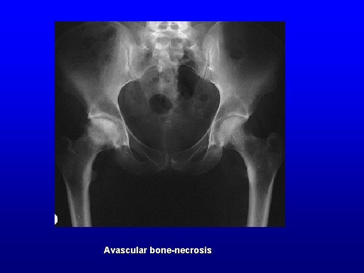 Avascular bone-necrosis 