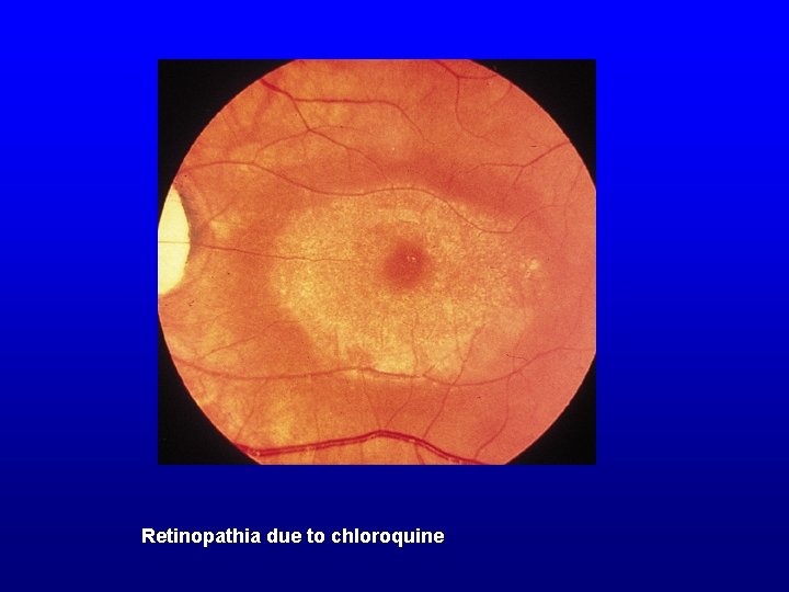 Retinopathia due to chloroquine 