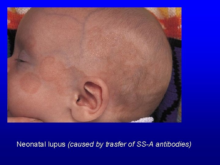 Neonatal lupus (caused by trasfer of SS-A antibodies) 