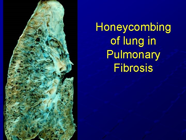 Honeycombing of lung in Pulmonary Fibrosis Honeycombing of lung in Pulmonary Fibrosis