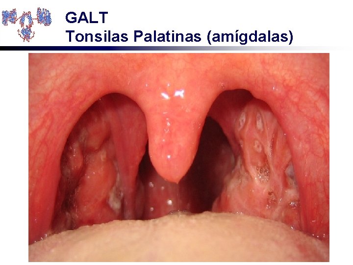 GALT Tonsilas Palatinas (amígdalas) 