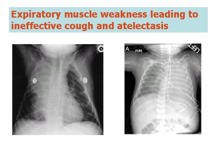 Expiratory muscle weakness leading to ineffective cough and atelectasis 