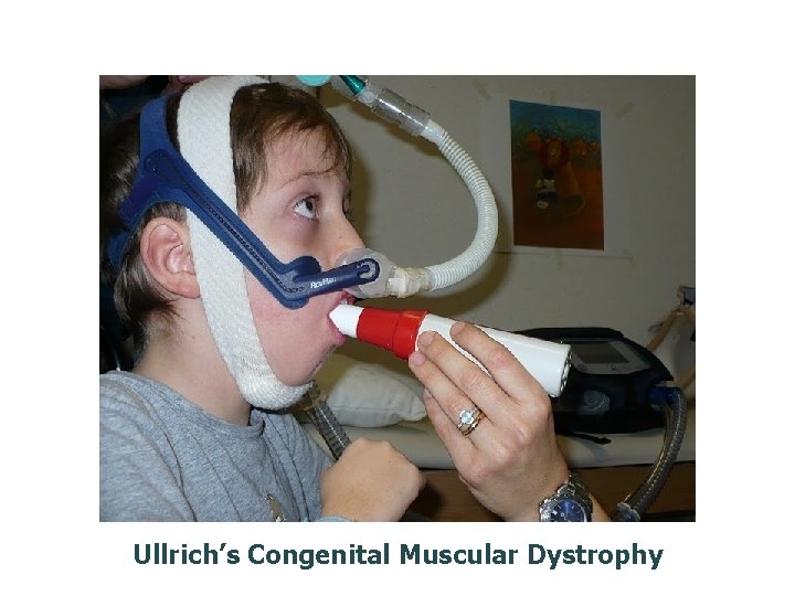 Ullrich’s Congenital Muscular Dystrophy Ullrich’s Congenital Muscular Dystrophy