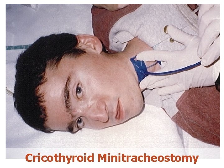 Cricothyroid Minitracheostomy 