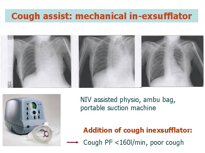 Cough assist: mechanical in-exsufflator NIV assisted physio, ambu bag, portable suction machine Addition of