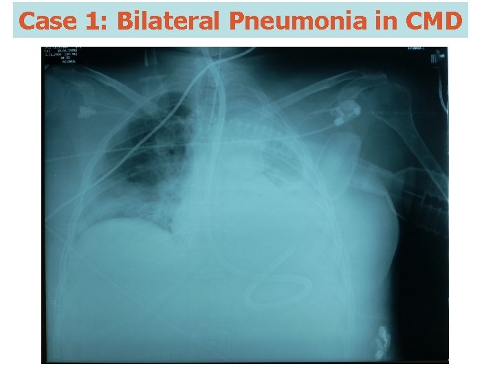 Case 1: Bilateral Pneumonia in CMD 