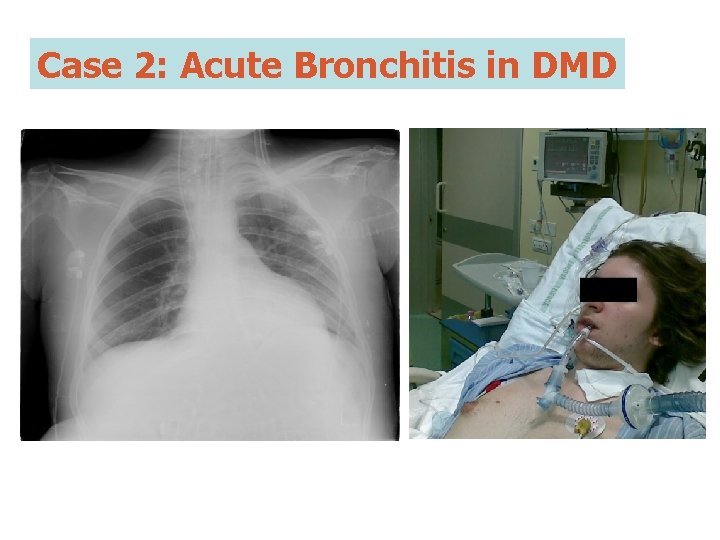 Case 2: Acute Bronchitis in DMD 