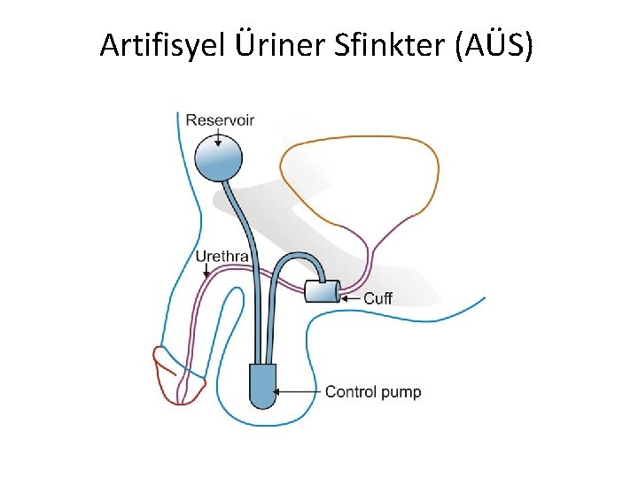 Artifisyel Üriner Sfinkter (AÜS) 