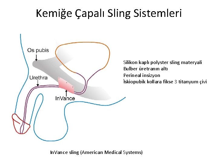 Kemiğe Çapalı Sling Sistemleri Silikon kaplı polyster sling materyali Bulber üretranın altı Perineal insizyon