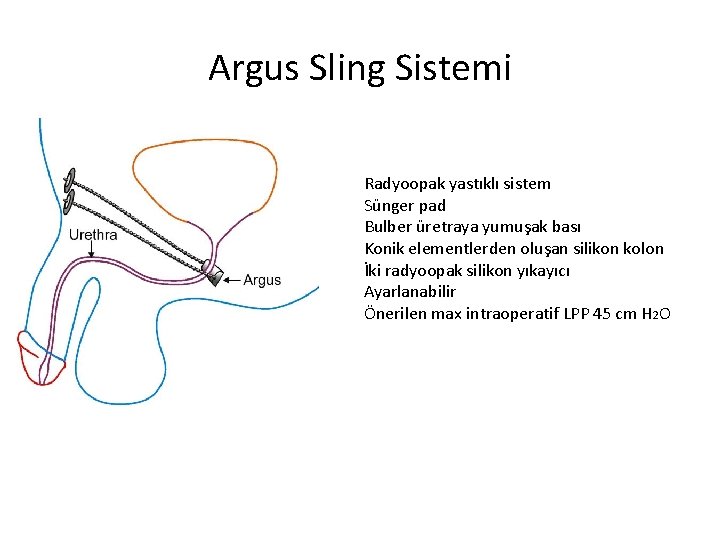 Argus Sling Sistemi Radyoopak yastıklı sistem Sünger pad Bulber üretraya yumuşak bası Konik elementlerden