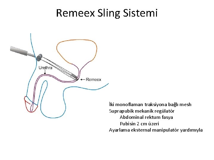 Remeex Sling Sistemi İki monoflaman traksiyona bağlı mesh Suprapubik mekanik regülatör Abdominal rektum fasya