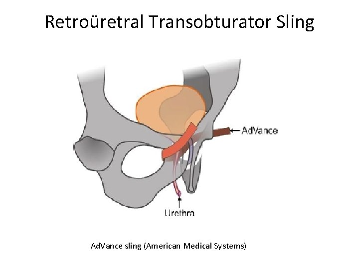 Retroüretral Transobturator Sling Ad. Vance sling (American Medical Systems) 