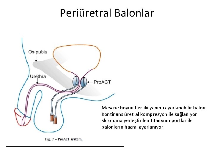 Periüretral Balonlar Mesane boynu her iki yanına ayarlanabilir balon Kontinans üretral kompresyon ile sağlanıyor