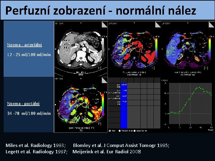 Perfuzní zobrazení - normální nález Norma - arteriální 12 - 25 ml/100 ml/min Norma