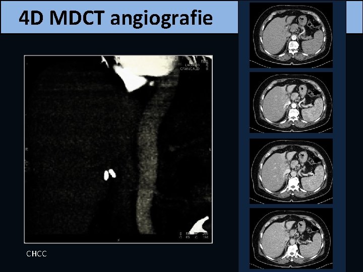 4 D MDCT angiografie CHCC 