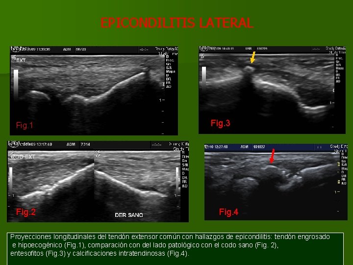 EPICONDILITIS LATERAL Fig. 1 Fig. 2 Fig. 3 Fig. 4 Proyecciones longitudinales del tendón
